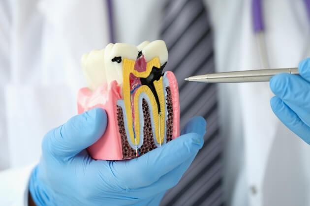  Dental Cap Cost in Hyderabad