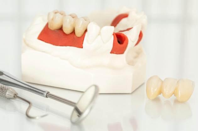 3D crowns in Hyderabad