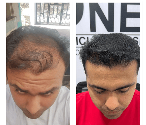 Best Hair transplant clinic in Hyderabad Best Hair transplant clinic in Hyderabad